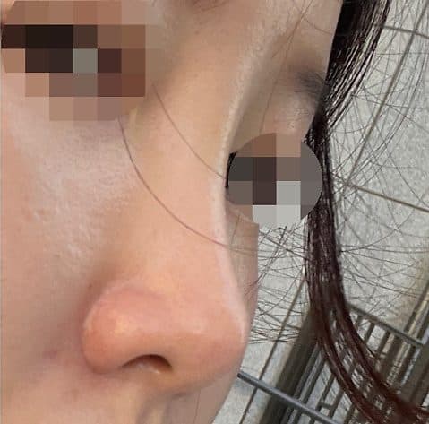 코필러 시술 후 사선