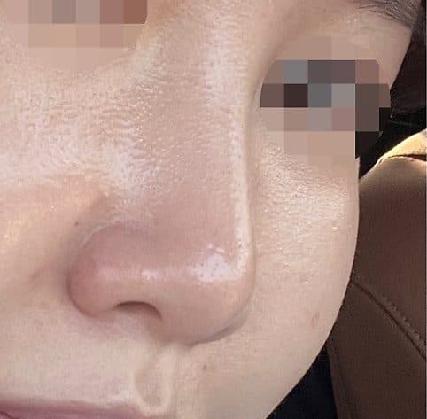 코필러 시술 전 사선