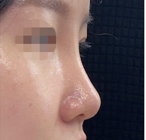 코필러 시술 후 측면