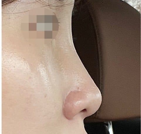 코필러 시술 전 측면